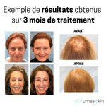 UltraRoller™ - Repousse Cheveux & Barbe